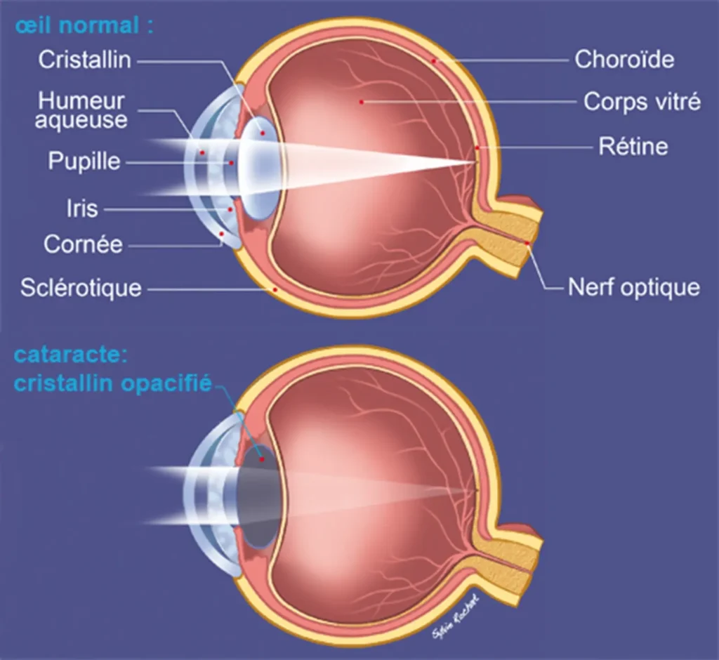 Schéma de la cataracte à Montpellier