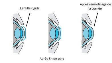 Orthokeratologie lentille de contact
