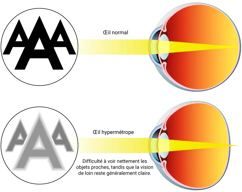 Schéma hypermétropie