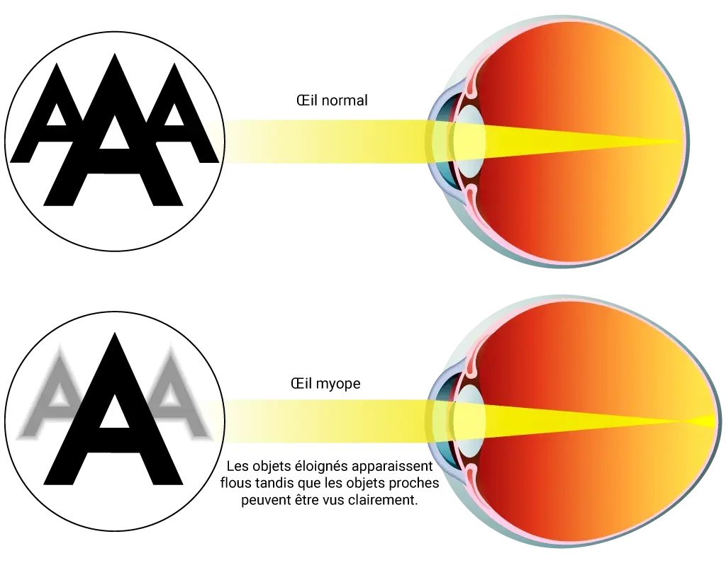 Schéma de la myopie
